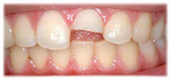 CASE 32: Broken Fractured Tooth - Before