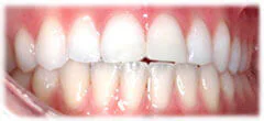 CASE 33: Emergency Treatment – Fractured Tooth - After