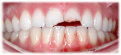 CASE 33: Emergency Treatment – Fractured Tooth - Before