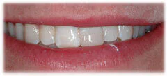 CASE 35: Broken Fractured Tooth - After