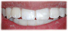 CASE 36: Emergency Treatment – Broken Tooth - After