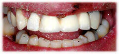 CASE 37: Broken Fractured Tooth - After