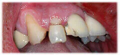 CASE 37: Broken Fractured Tooth - Before