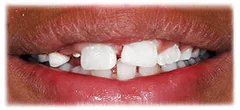 CASE 38: Emergency Treatment – Fractured Tooth - After