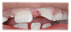 CASE 38: Emergency Treatment – Fractured Tooth - Before