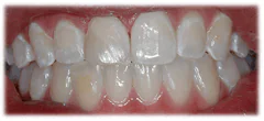 CASE 39: Emergency Treatment – Broken Tooth - After