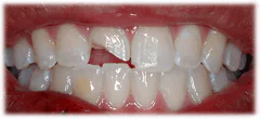CASE 39: Emergency Treatment – Broken Tooth - Before
