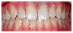 CASE 40: Emergency Treatment – Fractured Tooth - After