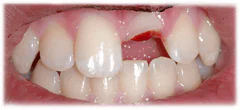 CASE 40: Emergency Treatment – Fractured Tooth - Before