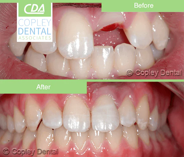 CASE 40: Emergency Treatment – Fractured Tooth
