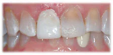 CASE 5: Emergency Dentist Fractured Broken Tooth - After
