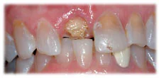 CASE 5: Emergency Dentist Fractured Broken Tooth - Before