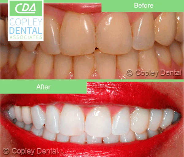 CASE 8: Cosmetic Dentistry – Teeth Whitening