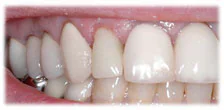 CASE 9: Emergency Treatment – Fractured Tooth - After