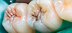CASE 43: Tooth-Colored Dental Fillings - Before