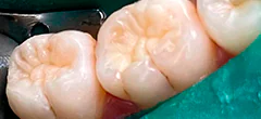 CASE 43: Tooth-Colored Dental Fillings - After