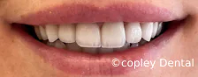 CASE 46: Emergency Treatment – Fractured Tooth - After