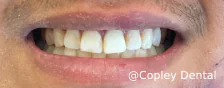 CASE 47: Fractured Tooth - After