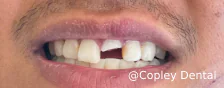 CASE 47: Fractured Tooth - Before