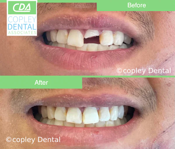 CASE 47: Fractured Tooth