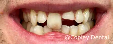 CASE 48: Fractured Tooth - Before