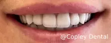 CASE 49: Fractured Tooth - After