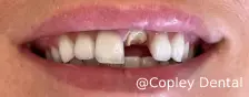 CASE 49: Fractured Tooth - Before