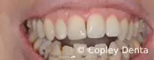 CASE 50: Fractured Tooth - Reimplantation - After