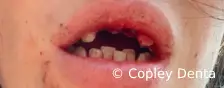 CASE 50: Fractured Tooth - Reimplantation - Before
