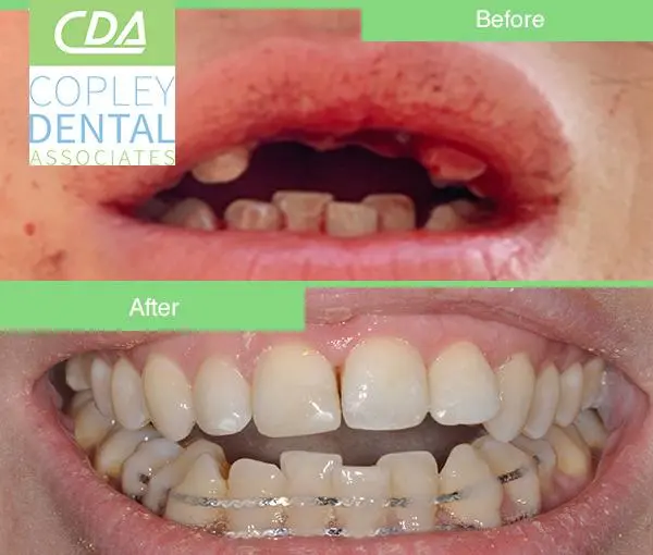 CASE 50: Fractured Tooth - Reimplantation