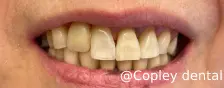 CASE 51: Emergency Visit – Fractured Tooth - After