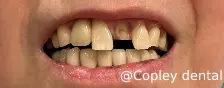 CASE 51: Emergency Visit – Fractured Tooth - Before